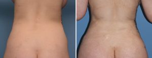 Rib Removal for Waistline reduction result back view Dr Barry Eppley Indianapolis