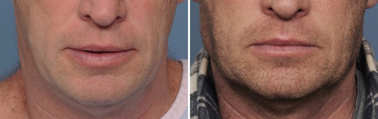 Plastic Surgery Case Study - Standard Vertical Lengthening Jaw Angle ...