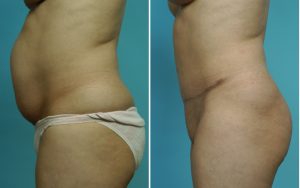 Plastic Surgery Case Study - The Extended Tummy Tuck in the