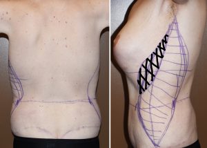 Plastic Surgery Case Study - The Vertical Backlift for Waistline