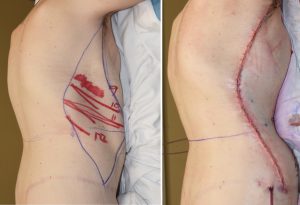 Plastic Surgery Case Study - The Vertical Backlift for Waistline