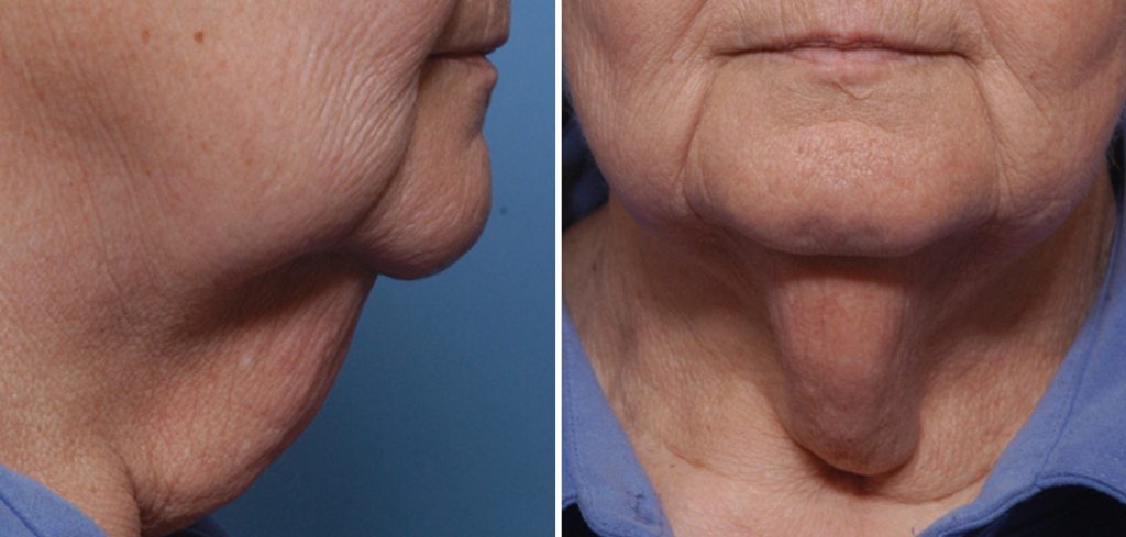 Plastic Surgery Case Study The Benefits Of The Direct Necklift In