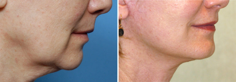 Plastic Surgery Case Study - Female Facelift with Chin-Prejowl Implant ...