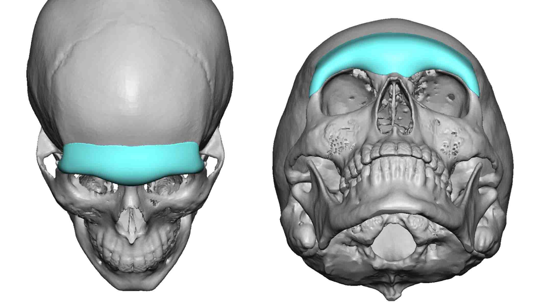 Custom Brow Bone Implant design top and submental views Dr Barry Eppley ...