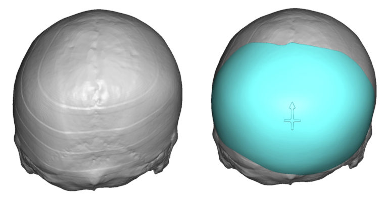 Custom Skull Implant Design Back View For Righth Occipital