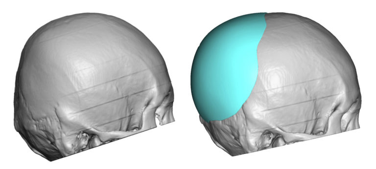 Plastic Surgery Case Study Custom Occipital Skull Implant For Adult
