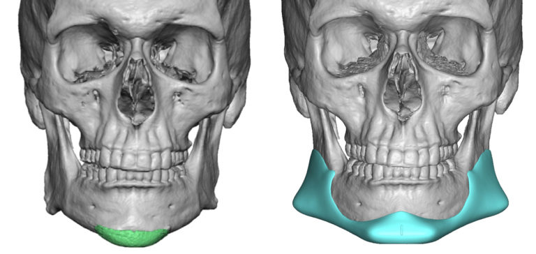 Plastic Surgery Case Study - Custom Jawline Implant Design for One ...