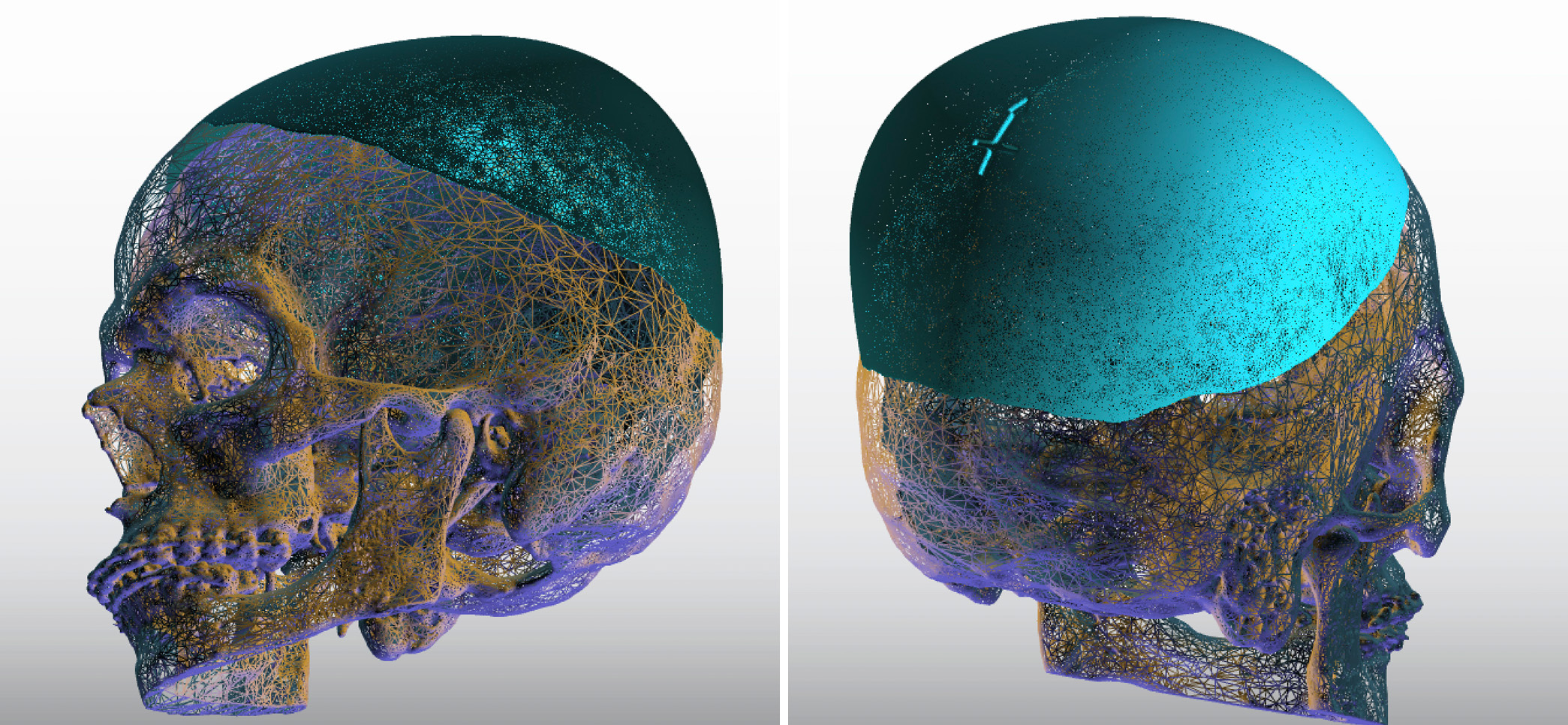 Third Enlarging Custom Skull Implant Dre Barry Eppley Indianapolis