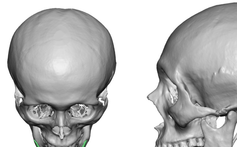 zygomatic arch x ray positioning