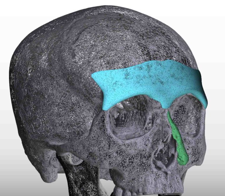 Plastic Surgery Case Study Male Custom Brow Bone Implant Placement