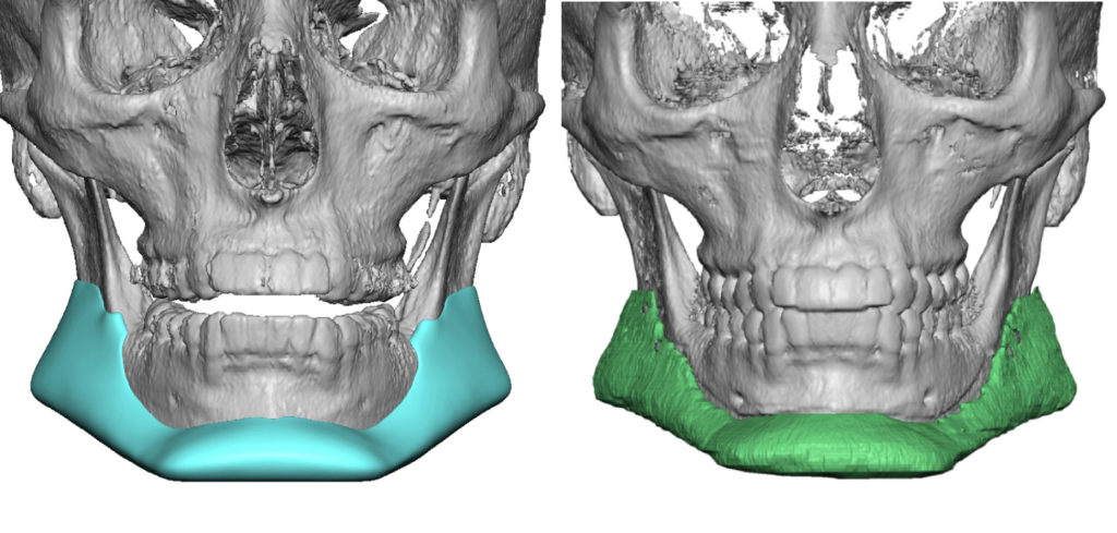 Plastic Surgery Case Study - Postoperative 3D Assessment of Custom ...