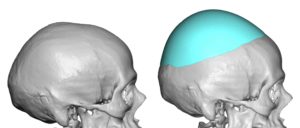 Plastic Surgery Case Study Male Custom Skull Heightening Implant