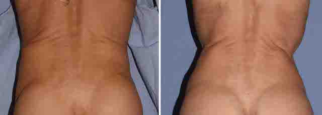 Plastic Surgery Case Study - Rib Removal Results in a Tall Thin