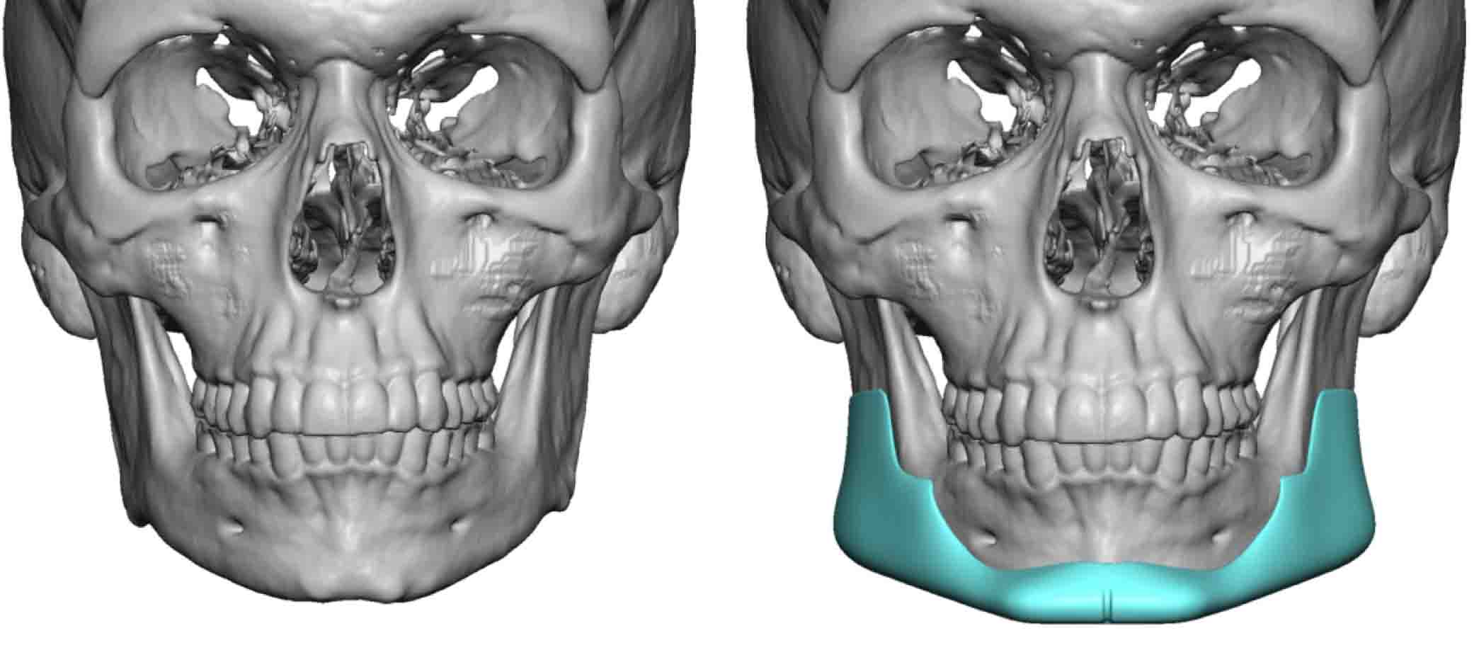 Male Custom Jawline Implant design front view Dr Barry Eppley ...