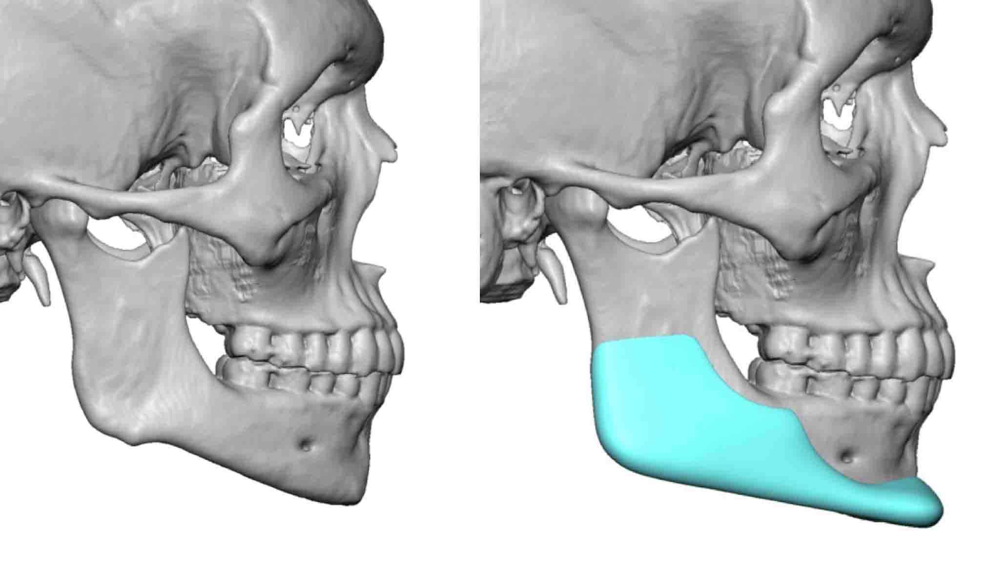 Male custom jawline implant design side view Dr Barry Eppley ...