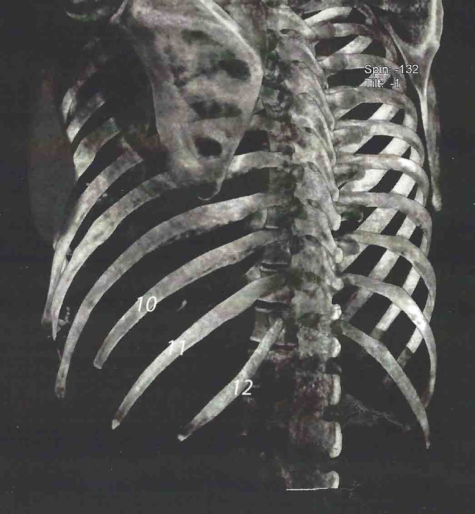 Understanding Rib Removal Surgery with 2D and 3D CT scans Explore