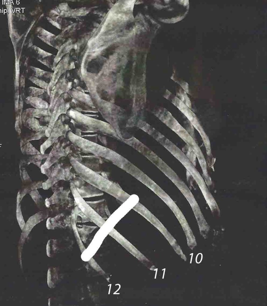 Understanding Rib Removal Surgery with 2D and 3D CT scans Explore