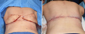 Plastic Surgery Case Study - The Braline Backlift for Removal of Back Rolls  - Explore Plastic Surgery