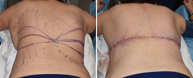 Bra Line Back Lift 195 Before & After Photos Lansing, MI - Michigan Plastic  Surgery