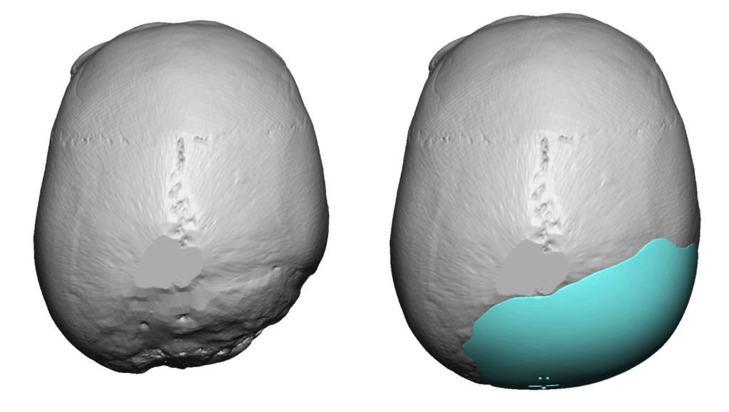 Plastic Surgery Case Study Custom Skull Implant For Right Occipital