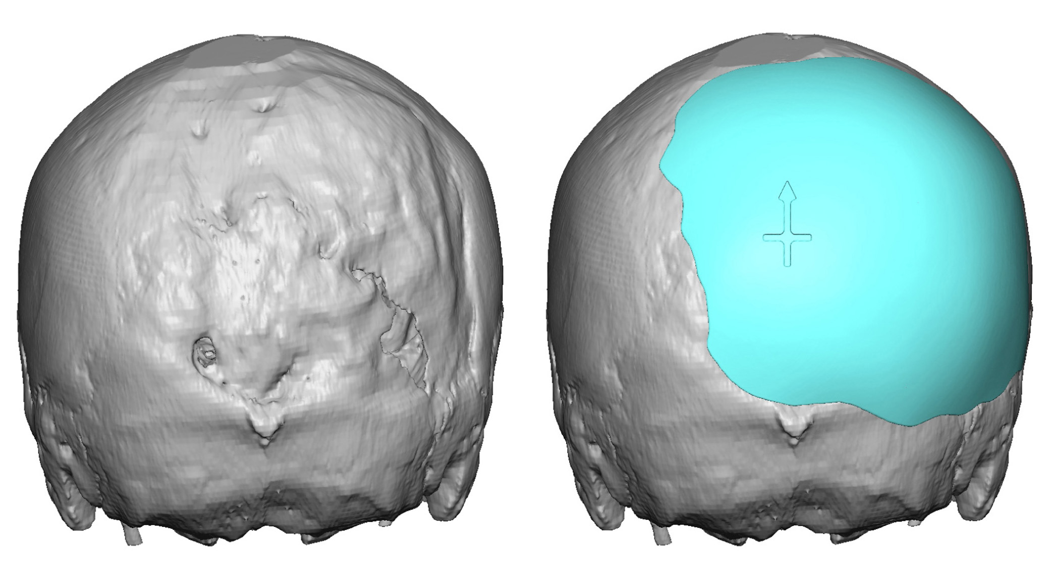 custom-right-occipitral-implant-design-for-skull-deformity-back-view-dr