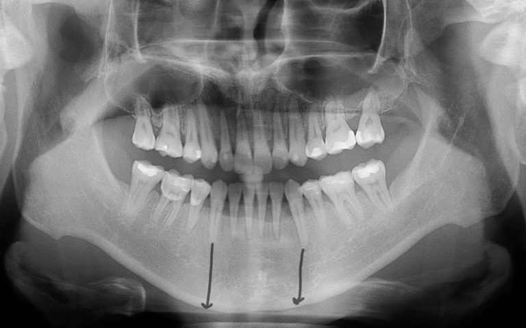 The Inferior Border Shave in Lower Facial Asymmetry Correction ...