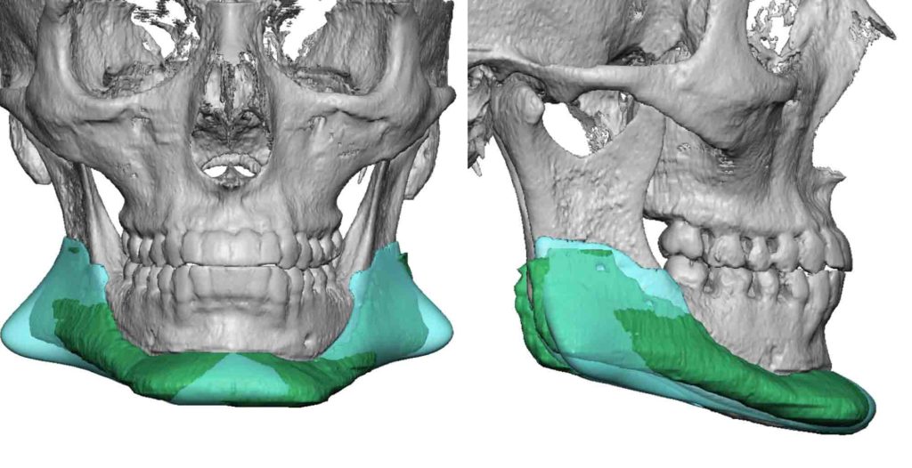 Plastic Surgery Case Study - Custom Jawline Implant Replacement ...