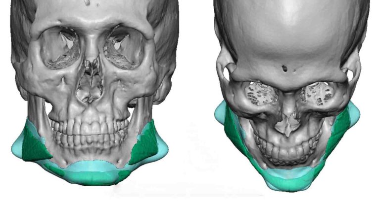 Plastic Surgery Case Study - Custom Jawline Implant Replacement of ...