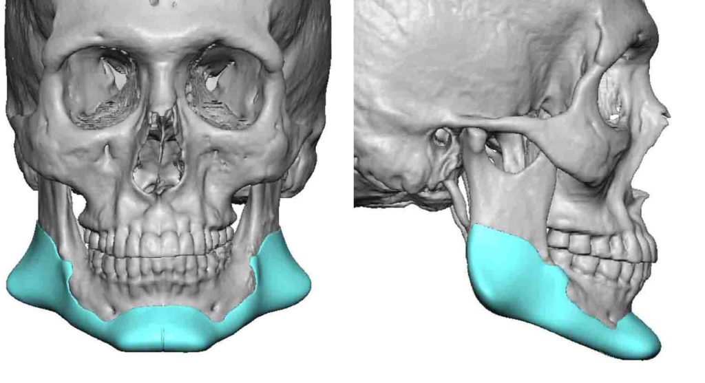 Custom Jawline Implant replacement for standard chin and jaw angle ...