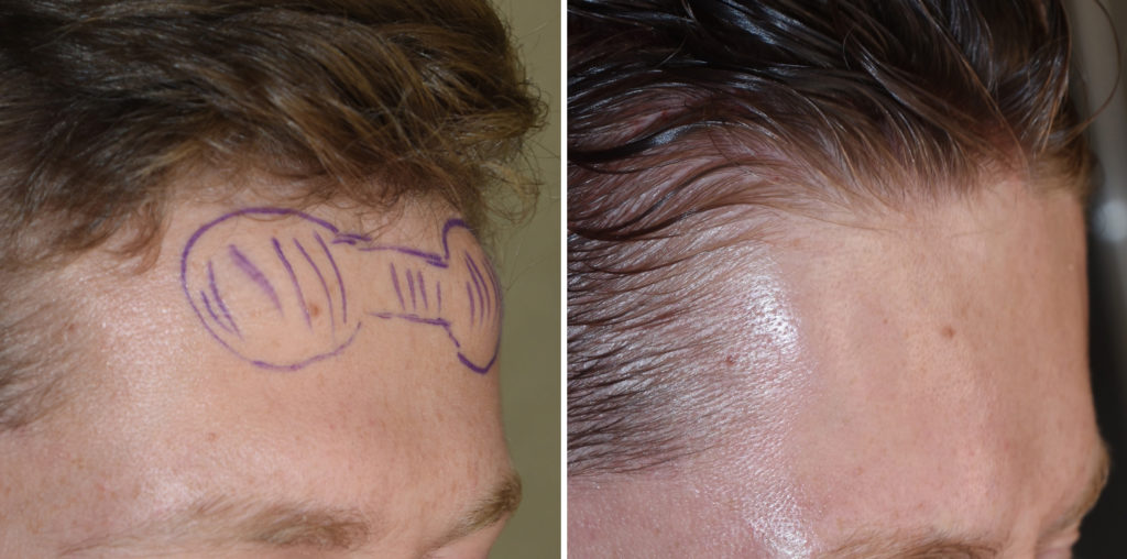 Forehead Horn Bony Forehead Reduction intraop DR Barry Eppley Indianapolis Explore Plastic Surgery