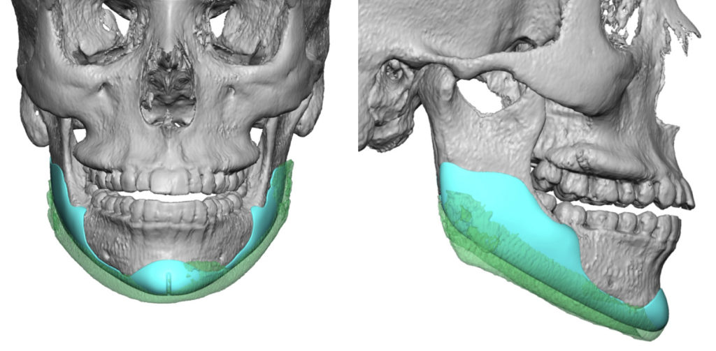 Plastic Surgery Case Study - Female Custom Jawline Implant for V-Line ...