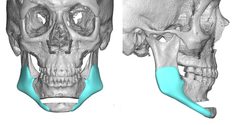 Plastic Surgery Case Study - Sliding Genioplasty Combined With Custom ...