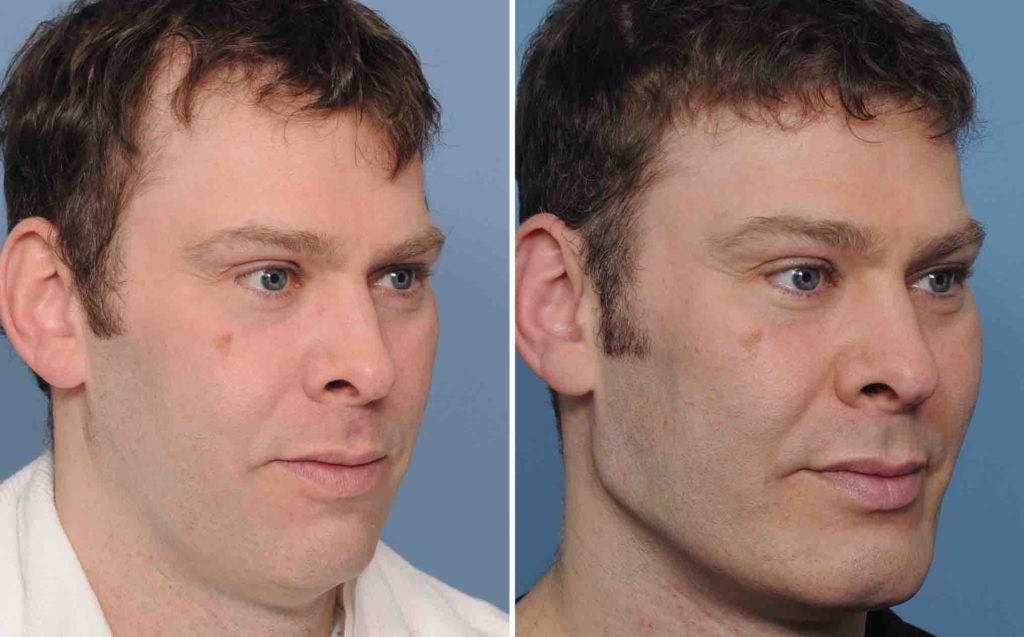 The Custom Jawline Implant Recovery Process When Do I See The Final Result Explore Plastic