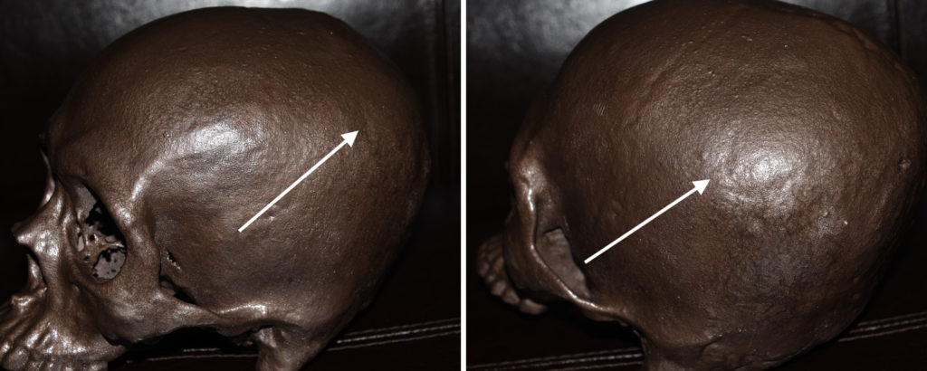 Parietal Eminence Skull Anatomy Dr Barry Eppley Indianapolis - Explore ...