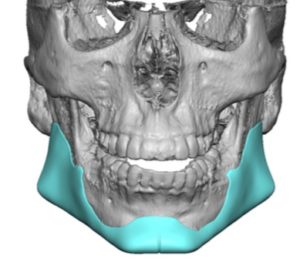 Custom Jawline Implant for Derotaing the High Jaw Angle Patient design ...