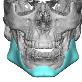 Plastic Surgery Case Study - Custom Jawline Implant Replacement in the ...