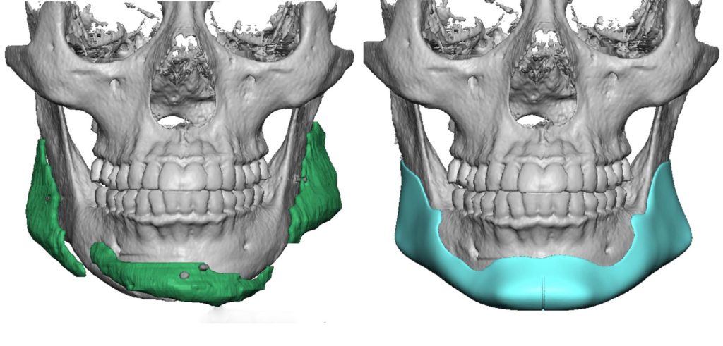 Plastic Surgery Case Study - Male Custom Jawline Implant for Standard ...