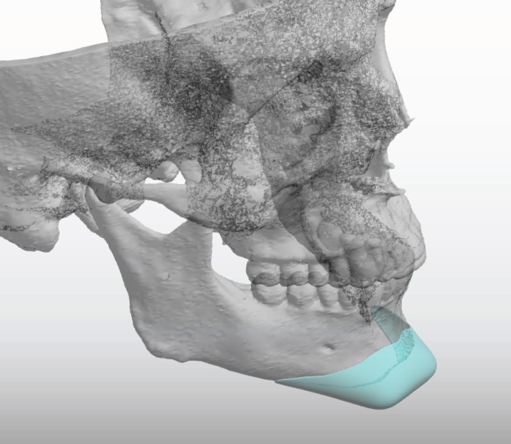 Plastic Surgery Case Study - Combined Horizontal and Vertical ...