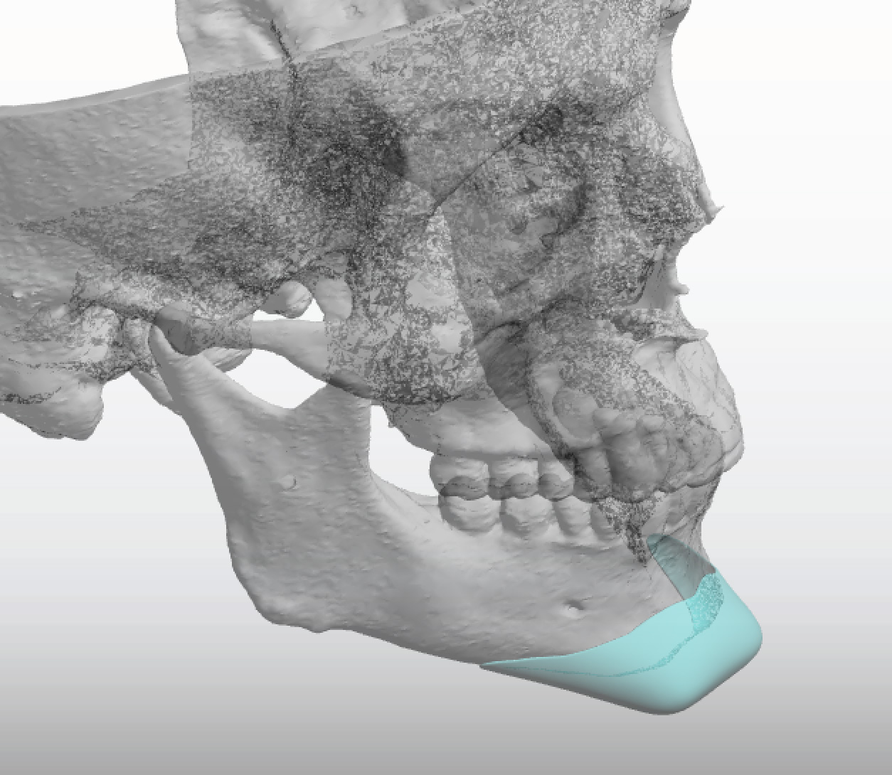 Custom Square Chin Implant 3d Design Side View Dr Barry Eppley 