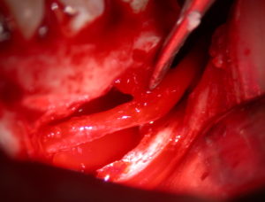 cyst exploreplasticsurgery indianapolis