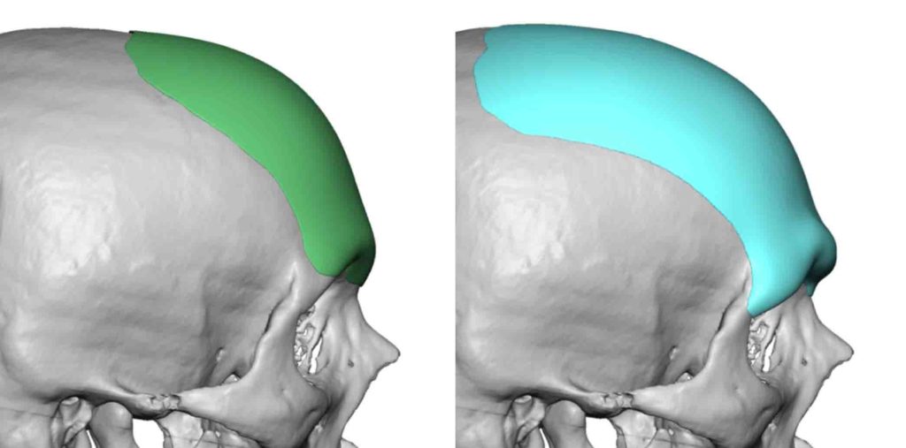 Male Custom Forehead Brow Bone Implant Replacement design side view Dr