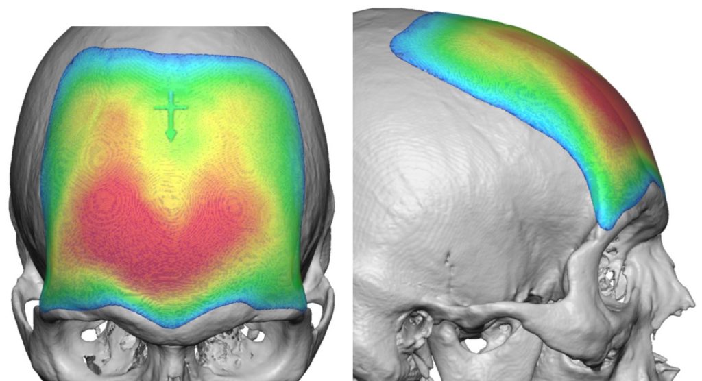Plastic Surgery Case Study Custom Forehead Implant for Correction of