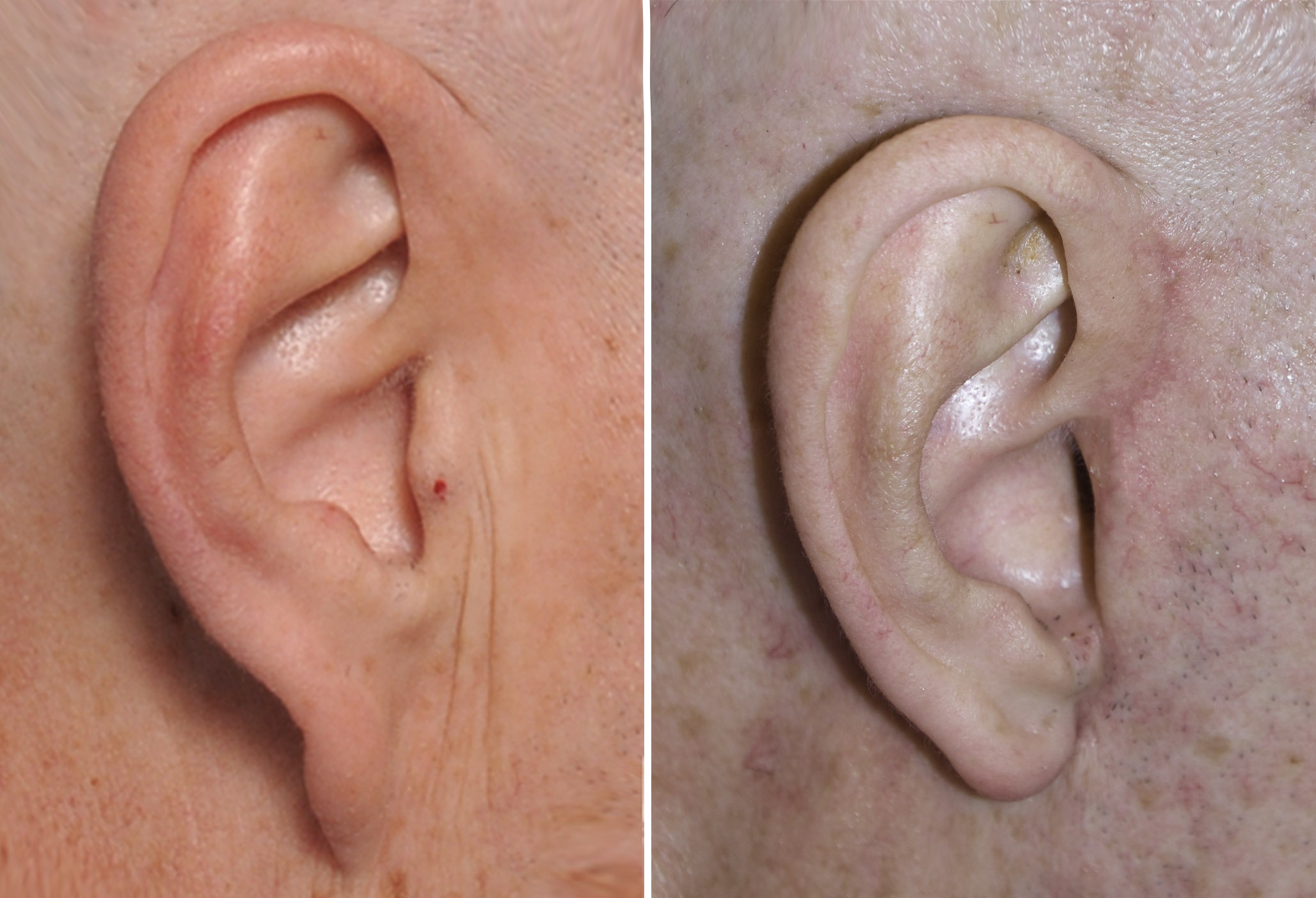 male-earlobe-correction-with-facelift-right-side-dr-barry-eppley