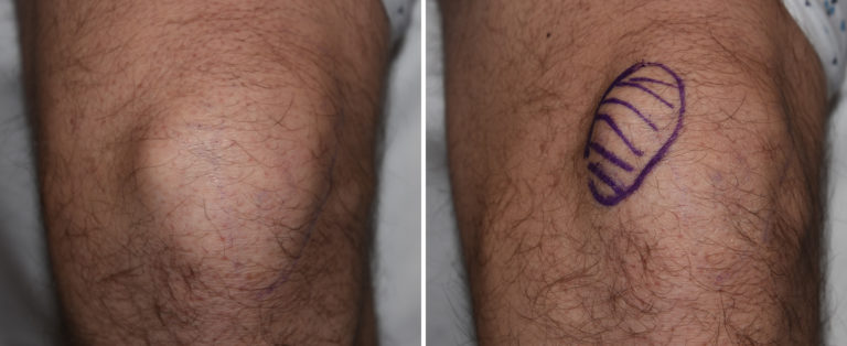 Plastic Surgery Case Study - Patellar Bump (Exostosis) Removal for