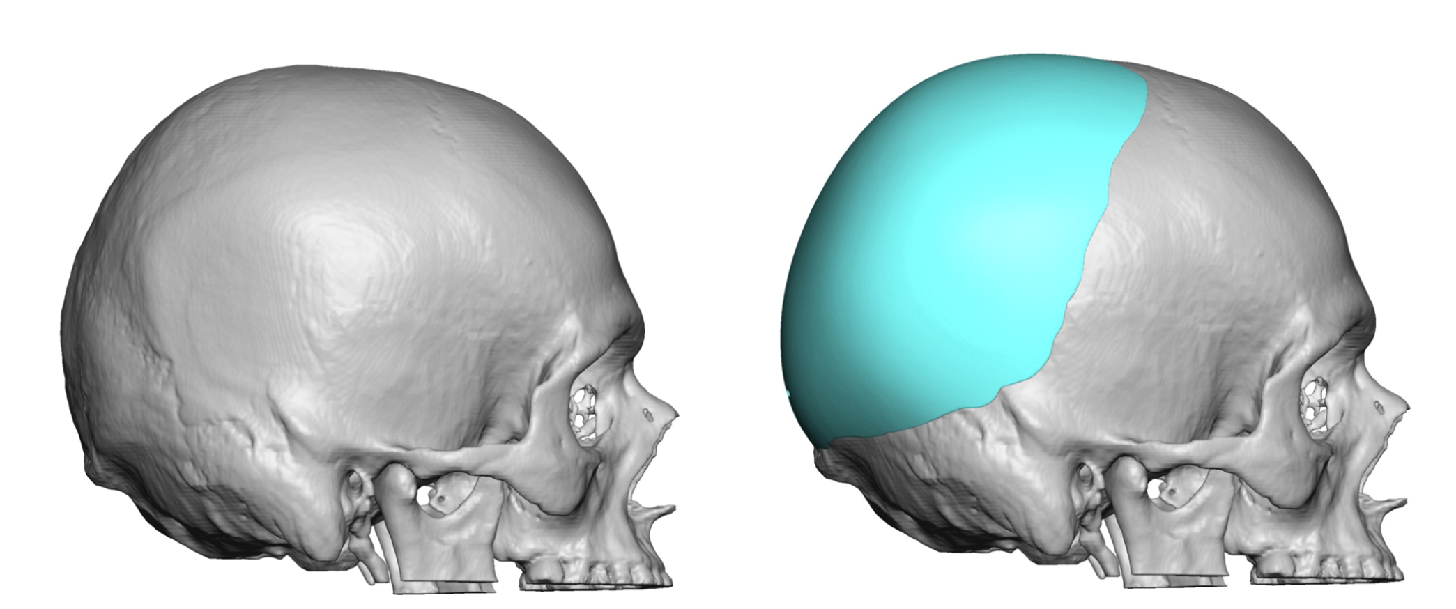 Custom Skull Implant Design For Occipital Asymmetry Right Side View Dr