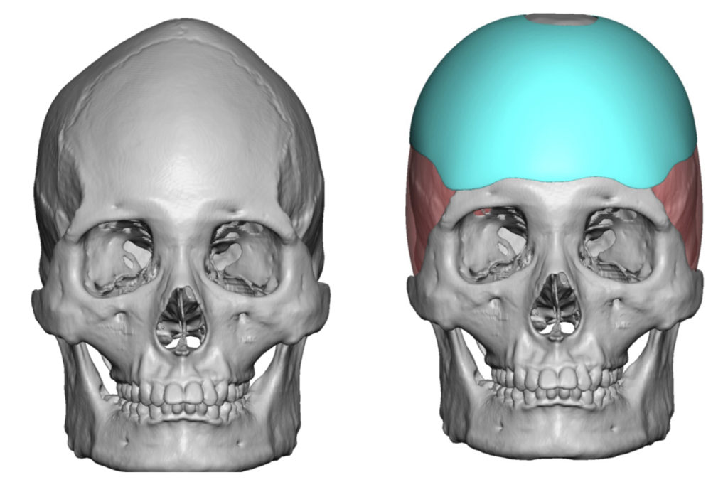 Plastic Surgery Case Study - Reshaping of the Inverted V Sagittal Crest ...