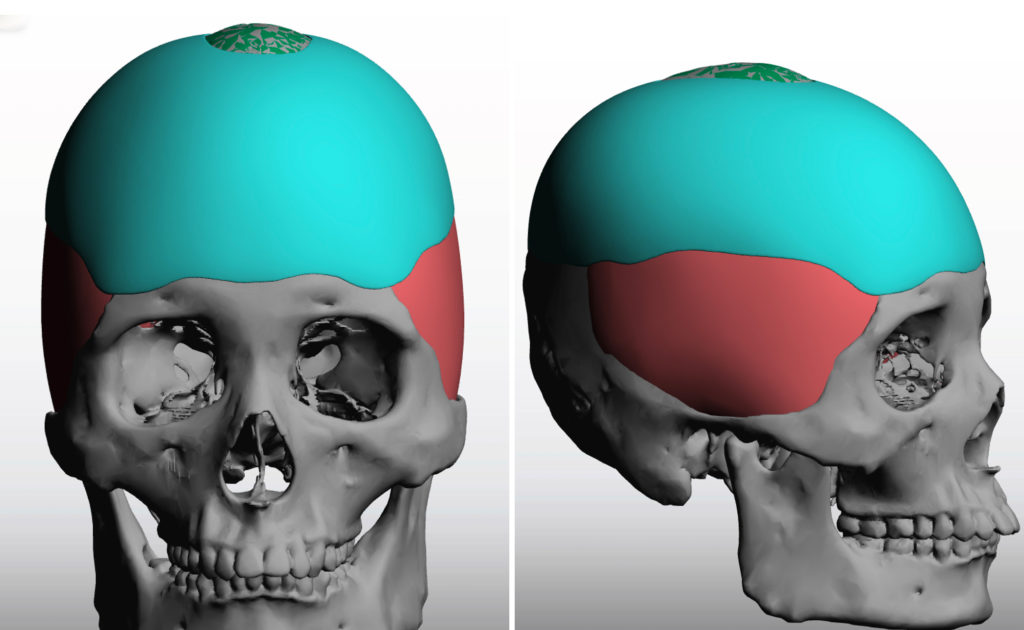 Custom Skull Implant with Sagittal Crest Reduction 3D design Dr Barry Eppley Indianapolis ...