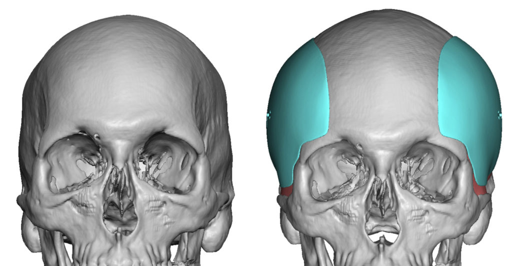 Plastic Surgery Case Study Custom Temporal Implants For A Complete
