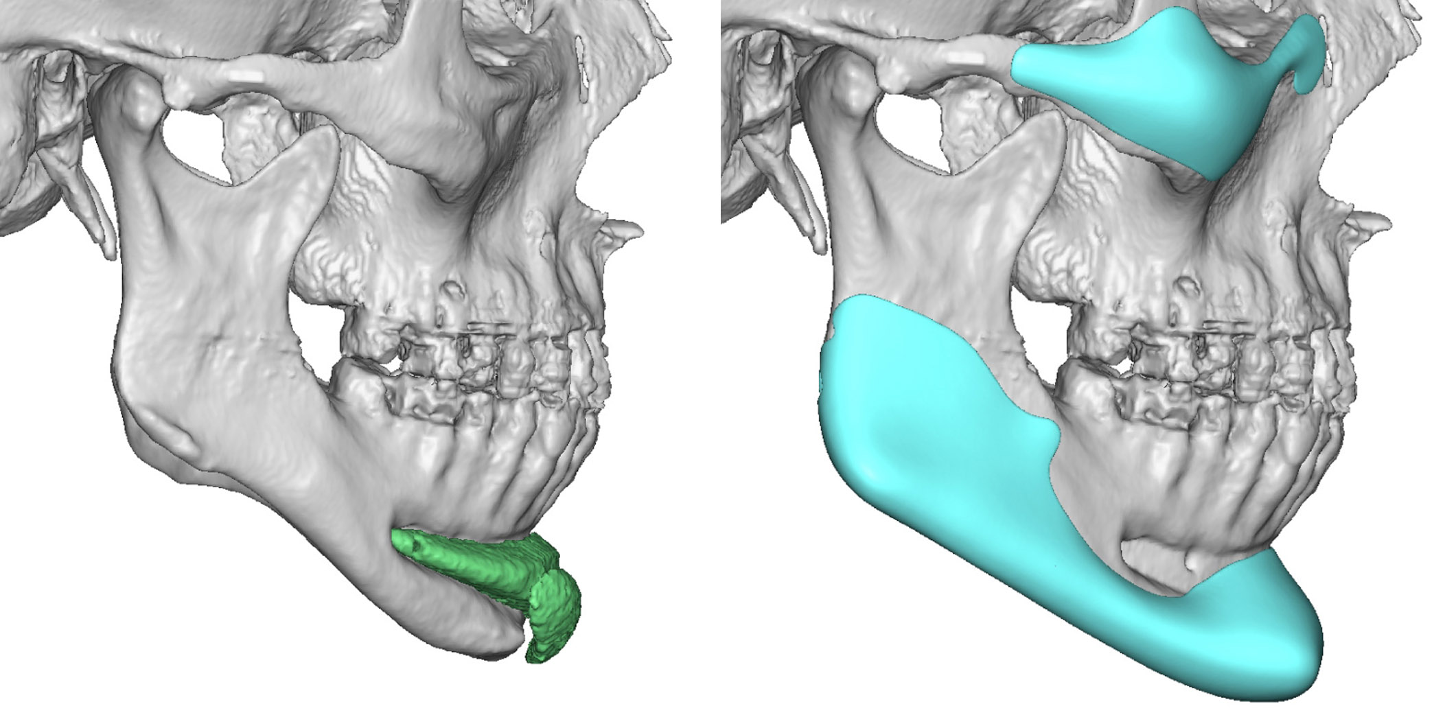 Older Male Customk Infraorbital-Malar and Jawline IMplants design side ...