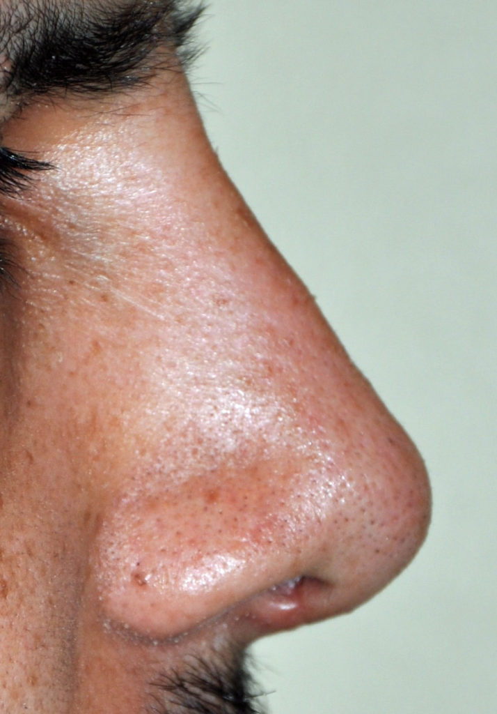 Basic Aesthetic and Surgical Concepts in Latino Rhinoplasty Explore